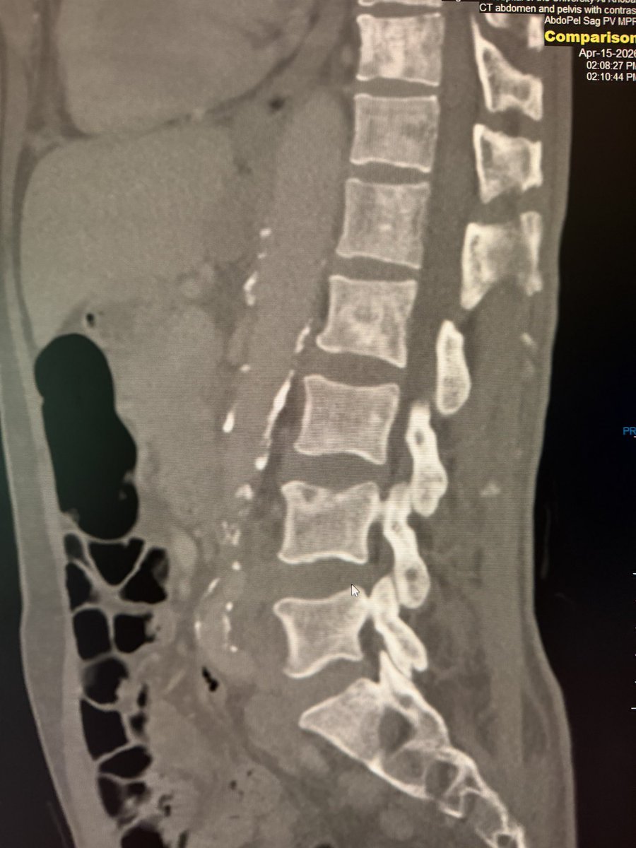 l_hsv8's tweet image. CXR : Cannon ball appearance
CT CAP : Bilateral hilar lymphadenopathy , heterogenoues enlarged prostate and multiple sclerotic osseous lesions .

Primary prostate Cancer with distant metastasis.