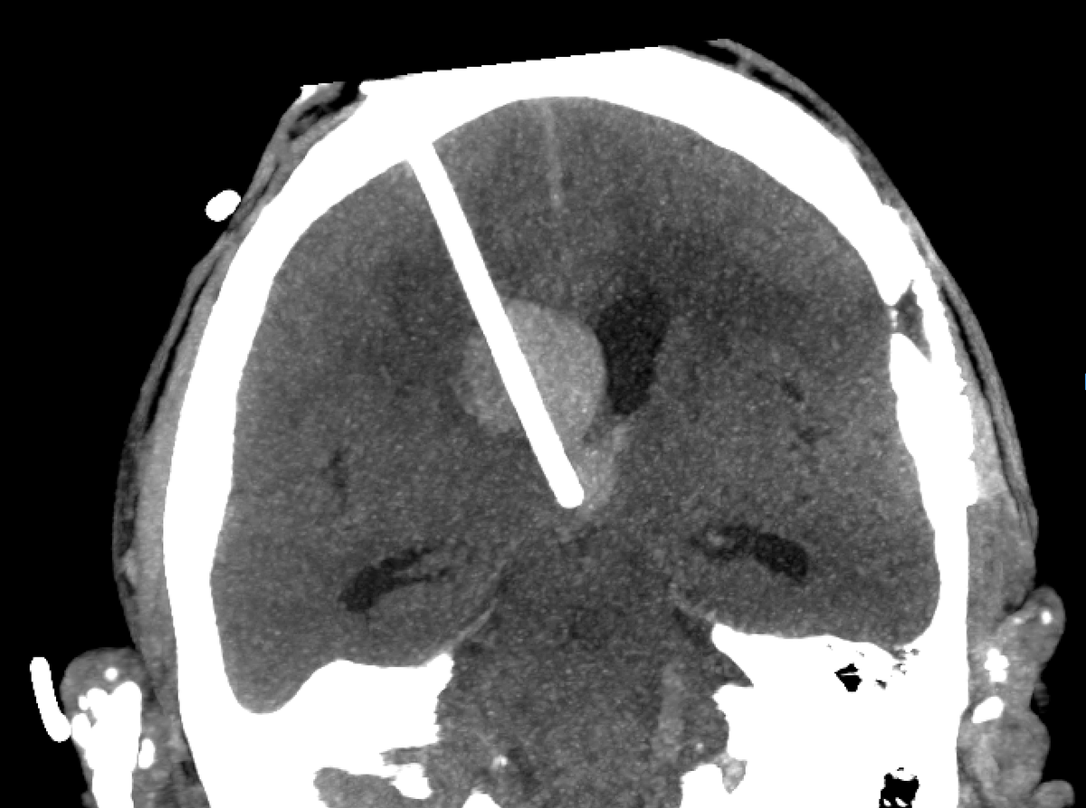 medivis_ai's tweet photo. We're proud to announce a significant step forward in neurosurgical care. Dr. @RandyDAmico_MD  has performed the first catheter placement navigated with Medivis' Cranial Navigation platform. It's a first that matters — intracerebral hemorrhage is one of the most time-sensitive and high-stakes conditions in neurosurgery, and precision is everything.

Post-op imaging confirmed accurate IRRAflow placement within the target hematoma, facilitating efficient clot evacuation.

Medivis' AR-guided platform delivers immersive, real-time anatomical visualization directly to the bedside and OR — giving surgeons the precision and confidence to navigate complex anatomy with clarity.

Dr. D'Amico's work exemplifies what's possible at the intersection of cutting-edge technology and surgical expertise.

Precision. Confidence. Better outcomes.

This is what the future of neurosurgery looks like. Congratulations to Dr. D’Amico and the entire team!