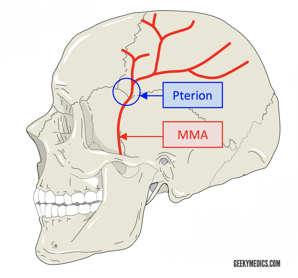 AB_drmd's tweet photo. الـ pterion هي منطقة في الجمجمة وهي مو عظمة بحد ذاتها بل هي نقطة التقاء أربع عظام في نفس المكان وهي الـ frontal bone والـ parietal bone والـ temporal bone والـ greater wing of the sphenoid bone، وتقع على الجانبين من الجمجمة في المنطقة الصدغية يعني فوق الأذن وللأمام قليلاً، وشكلها عند الالتقاء يشبه حرف H أو أحياناً يشبه حرف K.

اللي يخلي هذي المنطقة مهمة جداً من الناحية الطبية إنها تُعتبر أضعف نقطة في الجمجمة كلها، والسبب في ضعفها إن العظم في هذي المنطقة رفيع جداً مقارنةً بباقي مناطق الجمجمة وأحياناً سماكته ما تتجاوز ملليمترات قليلة، ف لو جاء أي ضربة أو صدمة على هذي المنطقة حتى لو كانت خفيفة نسبياً ممكن تكسر العظم بسهولة، واللي يزيد الأمر خطورة إن تحت هذي المنطقة مباشرةً يمر شريان مهم جداً اسمه الـ middle meningeal artery وهو فرع من الـ maxillary artery، وهذا الشريان يسير في أخدود أو قناة في السطح الداخلي للجمجمة في نفس منطقة الـ pterion، ف لما تصير كسر في الـ pterion هذا الكسر ممكن يمزق الـ middle meningeal artery، ولما الشريان يتمزق يبدأ الدم يتجمع بين العظم والـ dura mater في المساحة اللي نسميها الـ epidural space أو فوق الـ dura، وهذا التجمع الدموي يُسمى الـ extradural hematoma أو الـ epidural hematoma.

هنا تجي أخطر علامة سريرية لازم كل طالب طب يحفظها وهي الـ lucid interval، يعني المريض بعد الإصابة يفقد وعيه لفترة قصيرة ثم يرجع وعيه ويبدو بخير تماماً ويتكلم ويمشي وكأن ما صار شي، وهذه الفترة تسمى الـ lucid interval وهي خادعة جداً لأن الدم في هذا الوقت لا يزال يتجمع ببطء خلف العظم، وبعدين فجأة الضغط داخل الجمجمة يرتفع بشكل حاد ويضغط على الدماغ ويبدأ المريض يتدهور بسرعة ويفقد وعيه مرة ثانية وهذه المرة بشكل أخطر، وإذا ما تدخلنا بسرعة الضغط المتزايد يسبب الـ transtentorial herniation يعني الدماغ يبدأ ينزل من فتحة الـ tentorium cerebelli ويضغط على الـ brainstem وعلى العصب الثالث اللي هو الـ oculomotor nerve فتتسع الحدقة في نفس جهة الإصابة وهذي علامة خطيرة جداً اسمها الـ blown pupil.

التشخيص يتم بسرعة عن طريق الـ CT scan اللي يظهر فيه تجمع دموي عدسي الشكل أو biconvex لأن الدم يتجمع بين العظم والـ dura اللي هي ملتصقة بالعظم من الجوانب فيعطي شكل العدسة المحدبة من الجهتين، والعلاج هو جراحة طارئة عاجلة عن طريق عمل ثقب في الجمجمة اسمه الـ burr hole أو craniotomy لتفريغ الدم المتجمع وإيقاف النزيف قبل ما يصير ضرر دائم في الدماغ، وعشان كذا في الطوارئ أي مريض جاء بضربة على جانب الرأس حتى لو كان بخير وواعي لازم ما نطمن وننتبه للـ lucid interval ونراقبه بجدية.