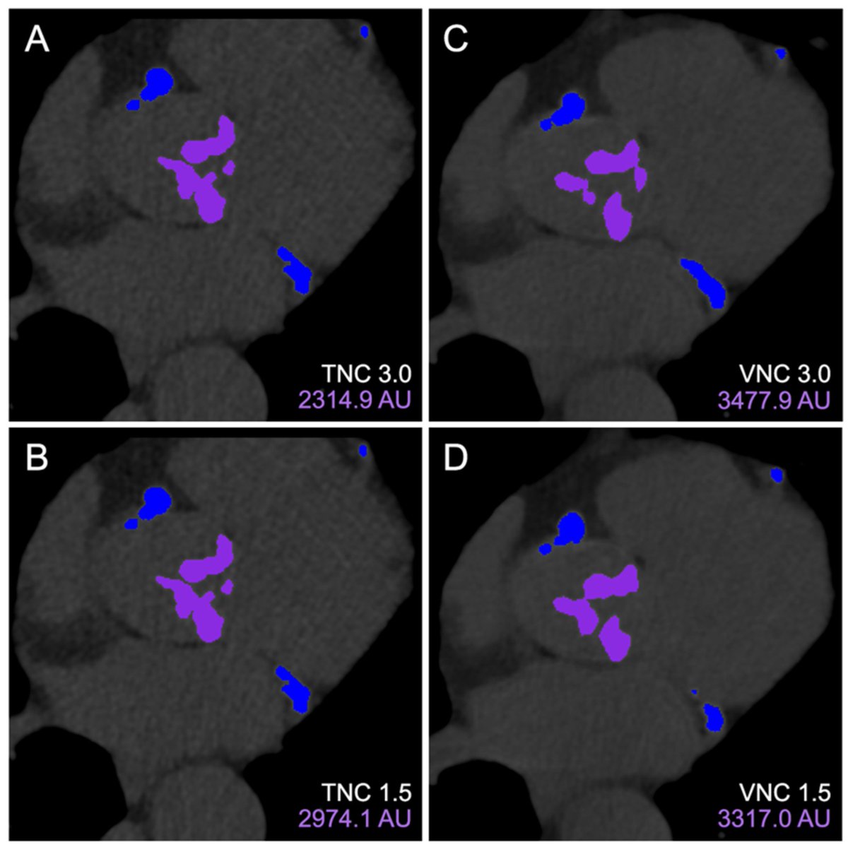 Tomography_MDPI's tweet image. 🗞️ Today we highlight the article "Aortic Valve Calcium Scoring Using True and Virtual Non-Contrast Reconstructions on Photon-Counting CT with Differing Slice Increments: Impact on Calcium Severity Classifications" 
➡️ brnw.ch/21x1CwY

#CardiovascularImaging #Heart
