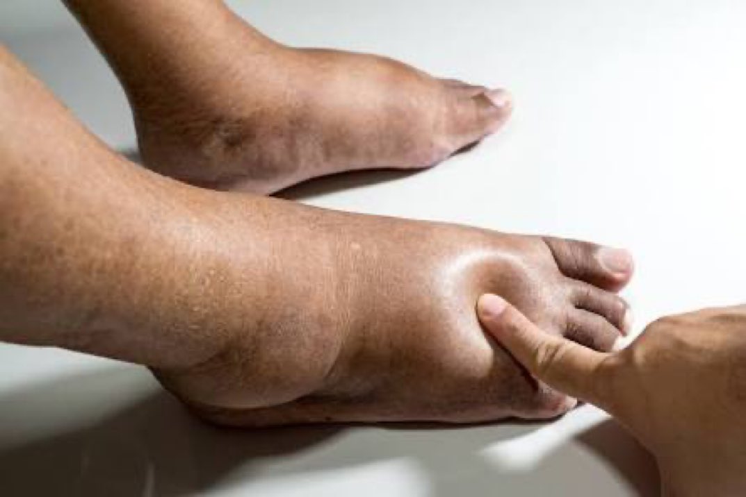 Doctors around the globe, what causes swollen legs in a pregnant woman?