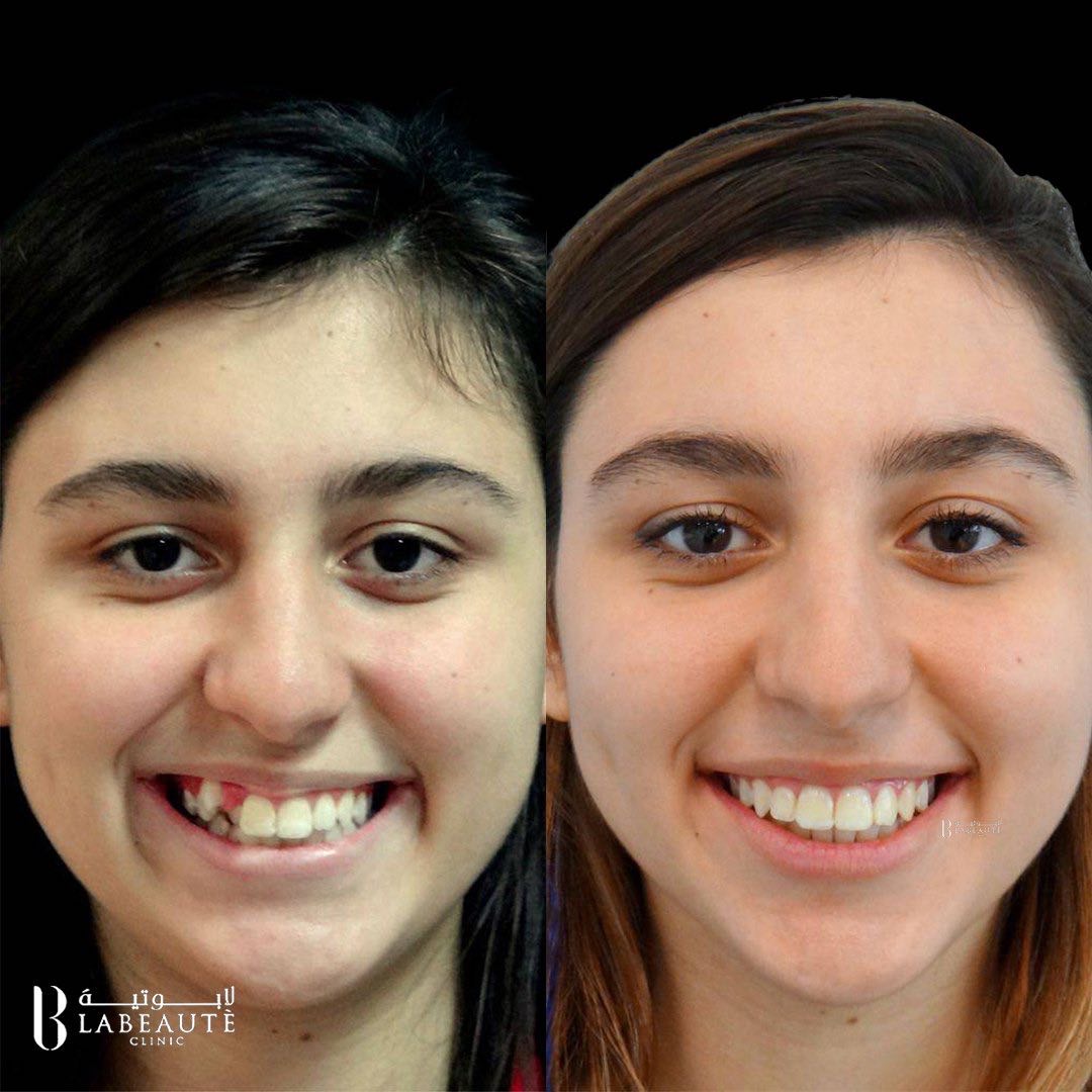 علاج ابتسامة الاطفال في #لابوتيه #الكويت_الآن للحجز والاستفسار :1888855
reachnetwork.co/labeaute
#جمهوريه_الموز #برشلونة_أتلتيكو_مدريد #صباح_الخير_ياكويت