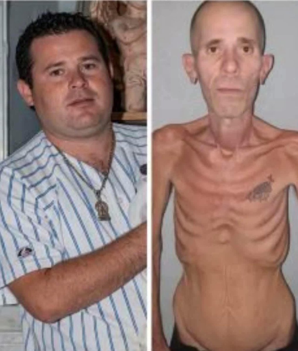 AsereYaPing's tweet image. #Hilo
Alexander Díaz Rodríguez, manifestante del 11 de julio de 2021 en Artemisa, fue excarcelado el pasado 4 de abril de 2026 tras cumplir íntegramente una condena de cinco años de privación de libertad.Antes de su detención pesaba aproximadamente 81 kilos. Al salir de prisión