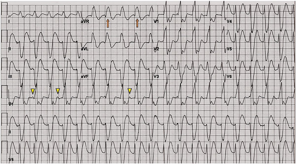 ESC_Journals's tweet image. How does flecainide induce ventricular tachycardia &amp;amp; how can it be managed? ow.ly/4cwL50YJ98B

#EHJCaseReports @Phiso_de @TJ_Yeo @aayshacader @BoldiKovacsMD @SukritiBanthiya @ANazmiCalik @O_Azizy_MD @saramoscatelli7 @EHJCREiC #CardioX #EPeeps