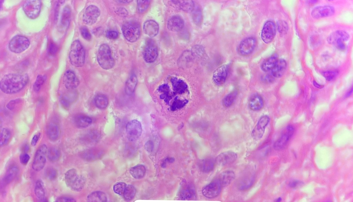 senaadsizdayanc's tweet image. atypical mitoses of day 🧚🏻‍♀️
#pathology
#lovepath
#mitosis
#breastcancer