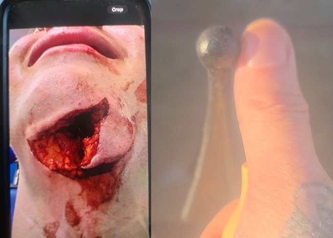jade63640529868's tweet photo. They told us Rocco 'slipped.' They called this 'Acceptable Service.' THIS is the reality of a 4cm deep internal puncture wound caused by @SuffolkPolice. The @IOPC_help have squashed the initial report. It’s time for the truth. #JusticeForRocco #PoliceBrutality @dal_babu https://t.co/MerX0DFinh
