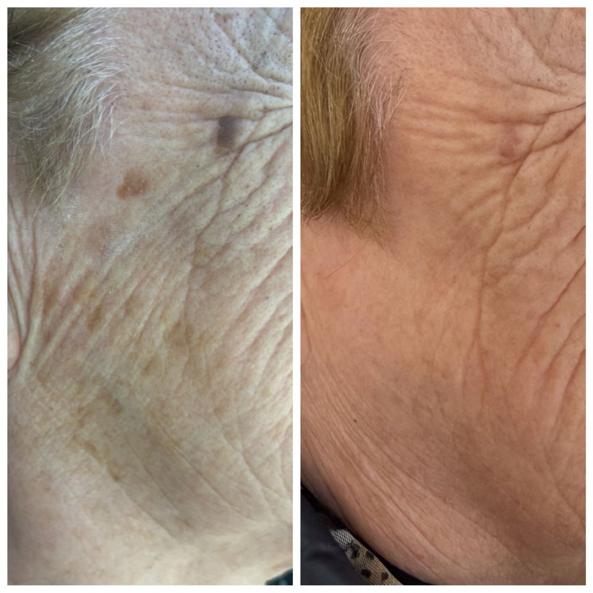 esteticatonidia's tweet photo. ✨️Resultados visibles en la mejora de manchas faciales con nuestro láser de neodimio ✨ 

Infórmate sin compromiso.
Centro de Estética Toñi Díaz. 

#manchas #laserfacial #pieluniforme #esteticafacial
[tratamiento despigmentante, láser neodimio, mejora del tono de la piel] https://t.co/thHlzdQaWn