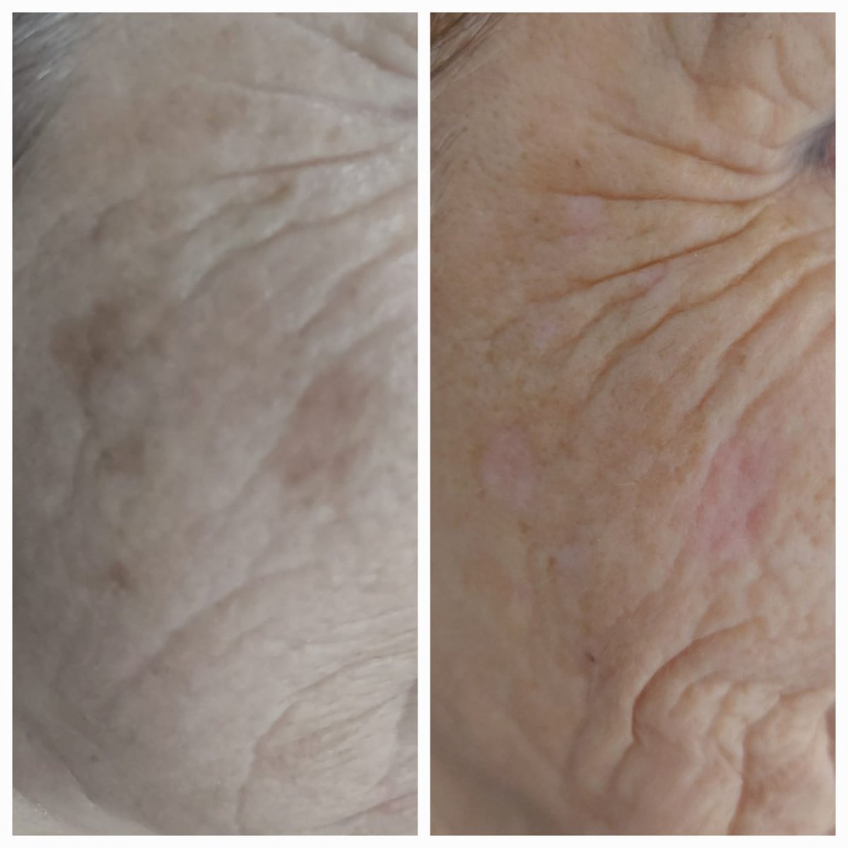 esteticatonidia's tweet photo. ✨️Resultados visibles en la mejora de manchas faciales con nuestro láser de neodimio ✨ 

Infórmate sin compromiso.
Centro de Estética Toñi Díaz. 

#manchas #laserfacial #pieluniforme #esteticafacial
[tratamiento despigmentante, láser neodimio, mejora del tono de la piel] https://t.co/thHlzdQaWn