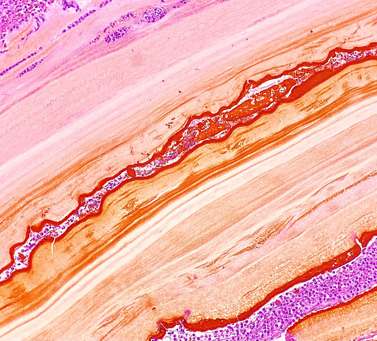 Nate_path's tweet photo. Bile leakage acting as its own histochemical stain highlighting the outer acellular laminated membrane of Echinococcus granulosus (classic hydatid cyst) #PathX #PathTwitter https://t.co/cs4Q3gtUkc