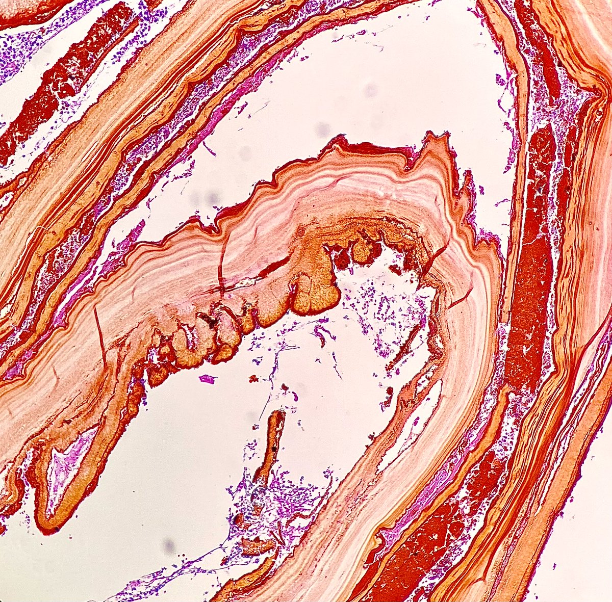 Nate_path's tweet photo. Bile leakage acting as its own histochemical stain highlighting the outer acellular laminated membrane of Echinococcus granulosus (classic hydatid cyst) #PathX #PathTwitter https://t.co/cs4Q3gtUkc