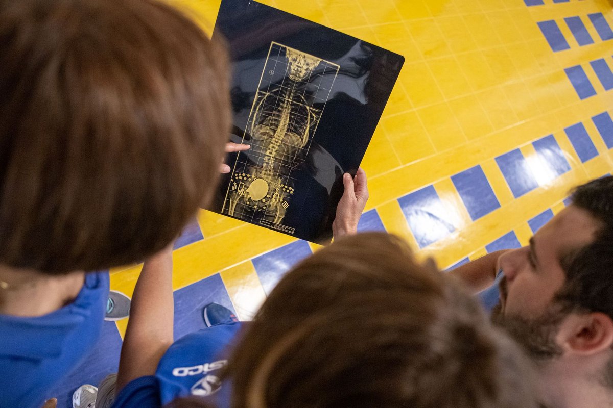 isicoitalia's tweet image. #Review: links between #lowtrunkmuscle mass/quality and #outcomes after #adultspinaldeformity (#ASD) #surgery are heterogeneous and mainly retrospective. Standardized #muscleassessment and #prospectivestudies using #sarcopenia criteria are needed.
#ISICO
pubmed.ncbi.nlm.nih.gov/41920498/