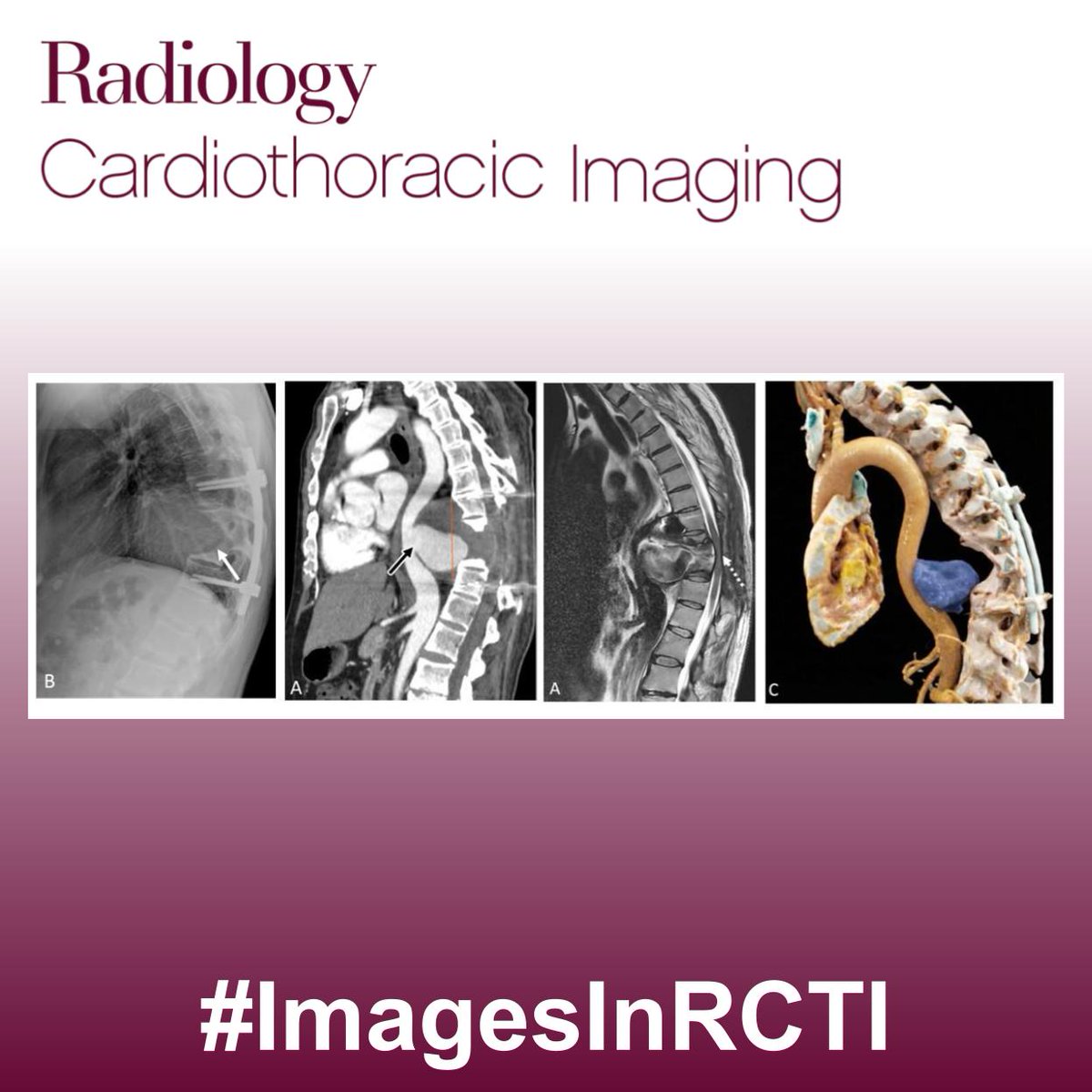 DaniEriol's tweet photo. ๐จ Ready to test your skills again?
A 42-year-old man presented with 2 months of progressive back pain, tingling, and bilateral lower-limb weakness.
What are the findings? What is the diagnosis?
#InTrainingRCTI #ImagesInRCTI
@RadiologyCTI https://t.co/kmzRu1LLhU