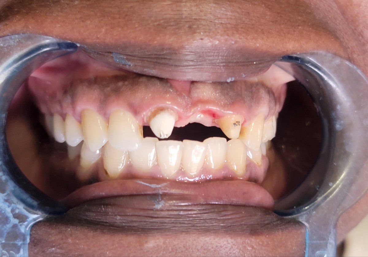 EmmaOpuyaileng's tweet photo. Choose full ceramic (Zirconia/Emax) crowns and bridges when restoring from teeth.

Before.                              After. https://t.co/ihqrejq62b