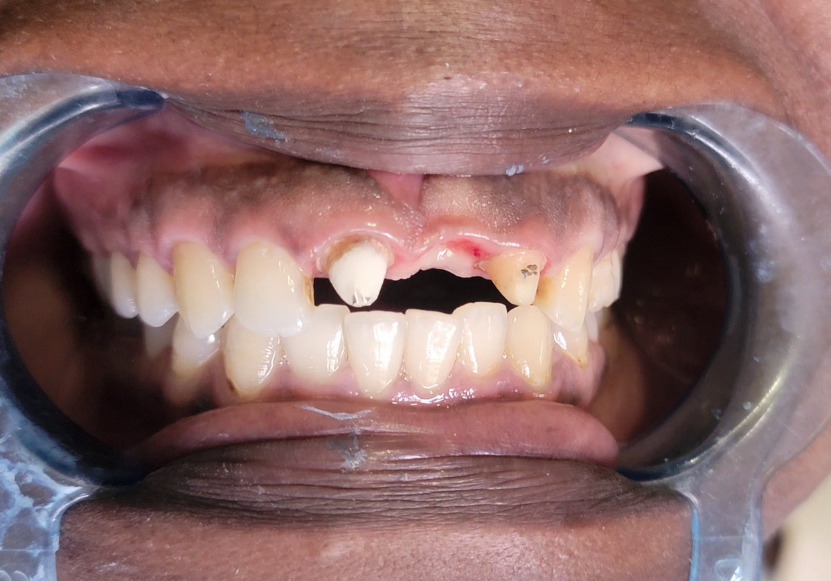 EmmaOpuyaileng's tweet photo. Choose full ceramic (Zirconia/Emax) crowns and bridges when restoring from teeth.

Before.                              After. https://t.co/ihqrejq62b