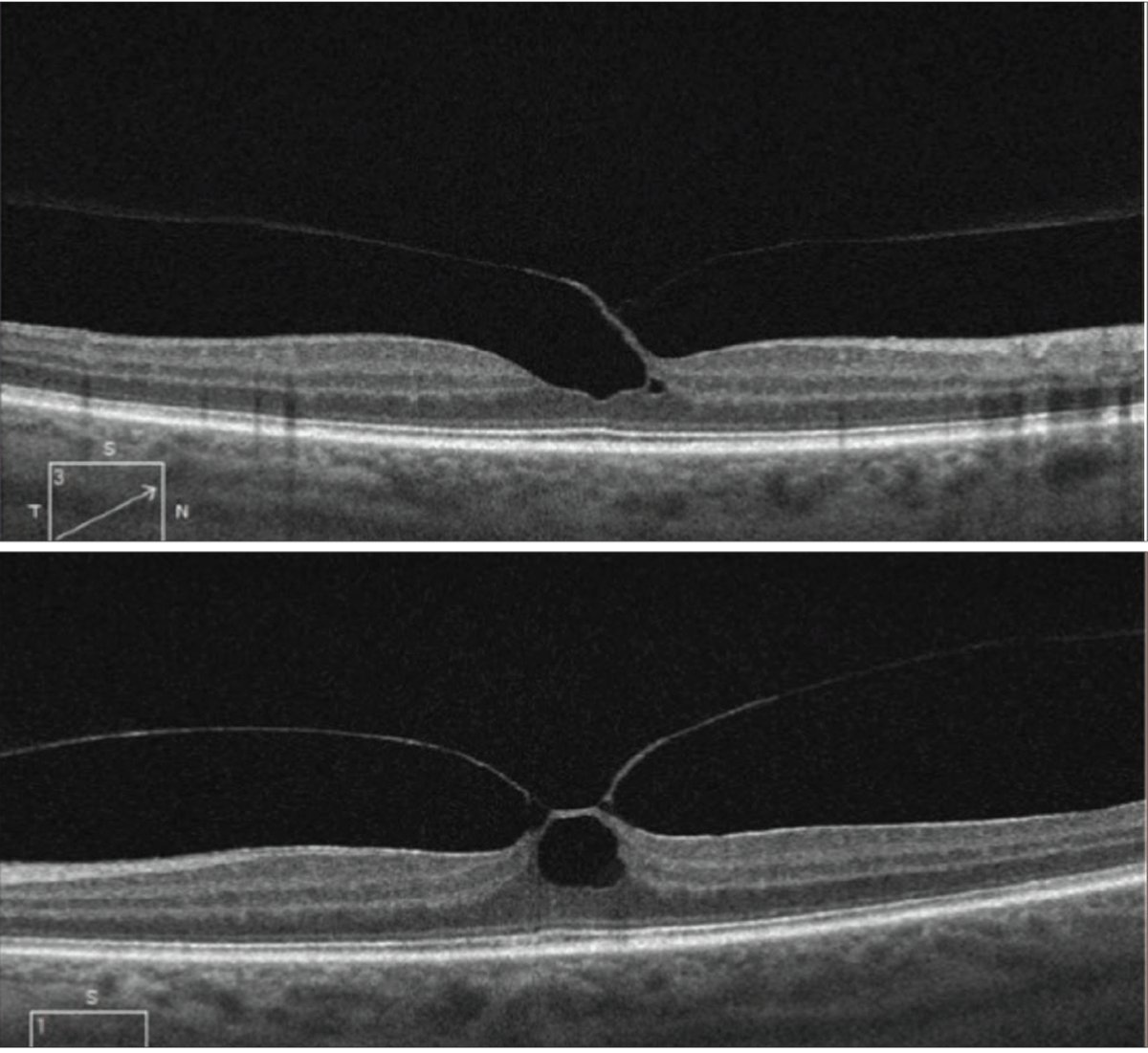 revoptom's tweet image. VMT, Lack of PVD are Risk Factors of Bilateral Macular Holes

Nearly all bilateral cases occurred within the first two years of follow-up.
reviewofoptometry.com/article/vmt-la…

#optometry #eyecare #retina #macularhole