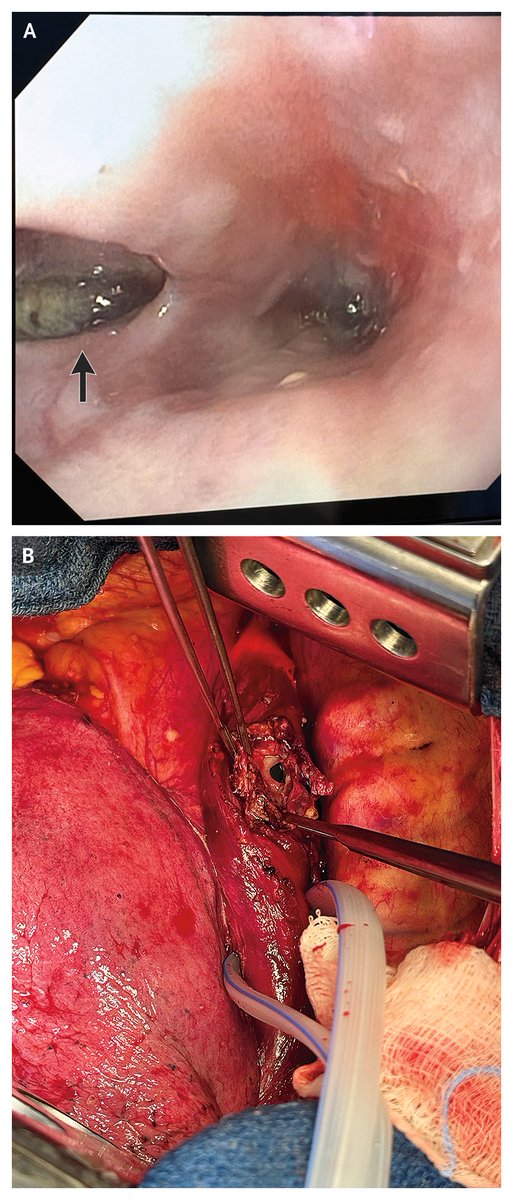 Case Record of the Massachusetts General Hospital (<a href="/MassGeneralNews/">MassGeneral News</a>): A 70-Year-Old Woman with a Racing Heart, Fatigue, and Dyspnea nejm.org/doi/full/10.10…

#AFib #Cardiology