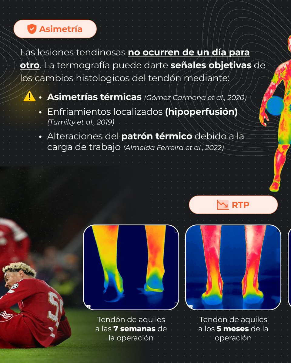 ThermoHuman's tweet photo. When the tendon ruptures, the image is shocking. But the most important thing is that it doesn't happen overnight. Tendons change before they break. And thermography can help us detect those changes:
⚠️ Thermal asymmetries
⚠️ Hypoperfusion
⚠️ Alterations 
https://t.co/XTFYsYSXMH https://t.co/7glSbwI5y4