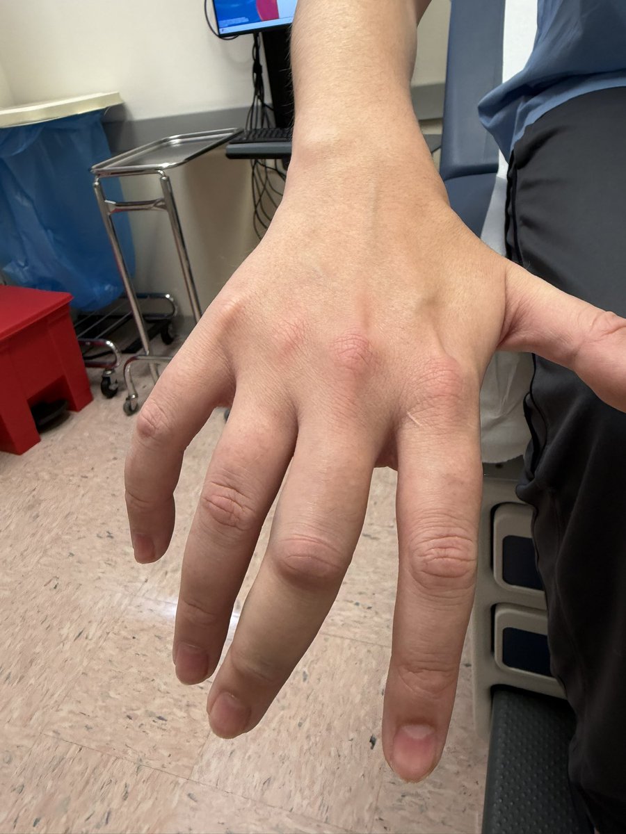 Thats_Whacky's tweet photo. @JoezMcfLy My middle finger last week after attempting to catch a homerun ball lol https://t.co/efHy7ToZJu