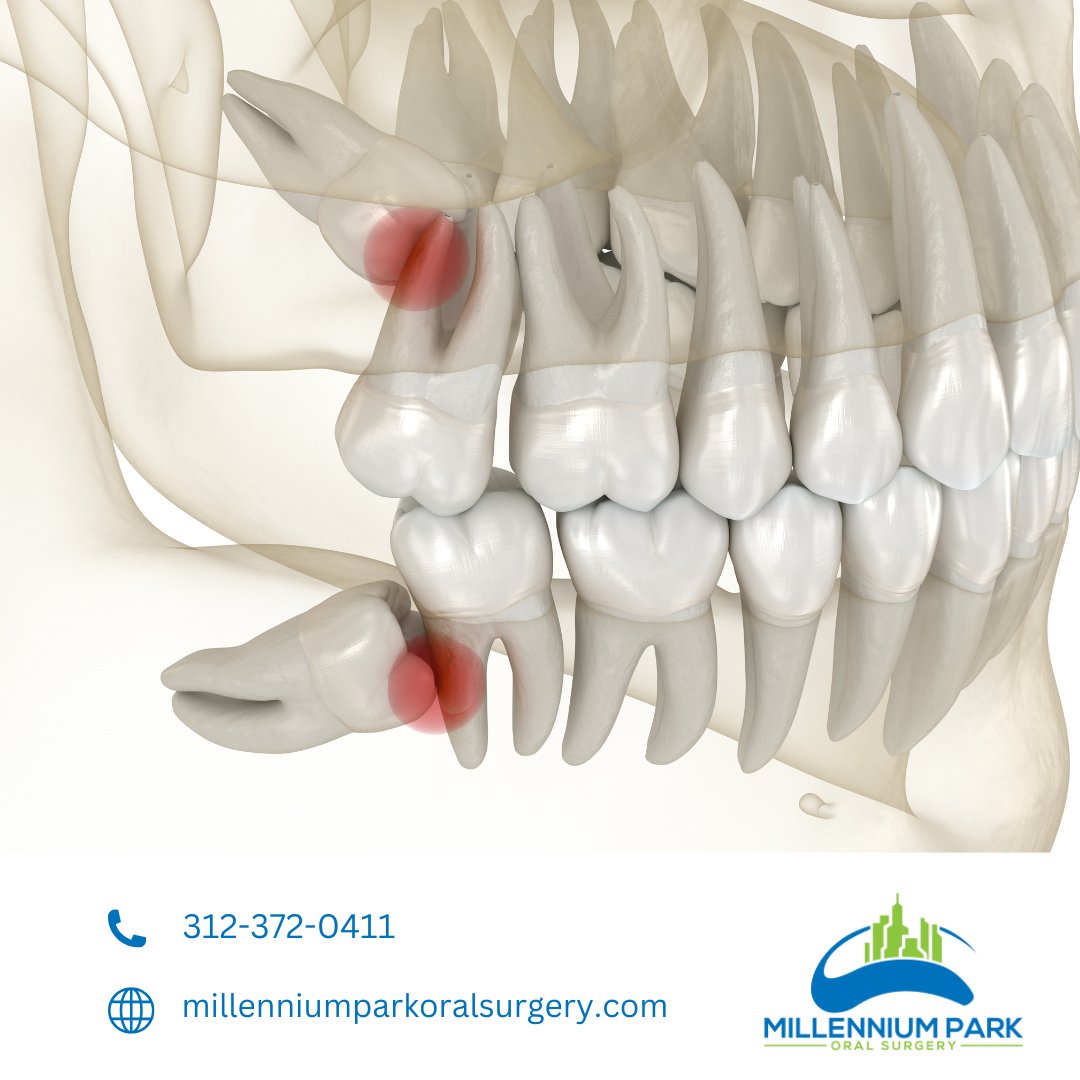 MPOS_IL's tweet photo. 🦷 Impacted wisdom teeth can cause jaw swelling, pain, difficulty opening your mouth, and even a bad taste or bleeding gums. These could be signs of an issue!

If you have symptoms, call 📞 312-372-0411 for more info!

#MPOS #ImpactedWisdomTeeth #OralHealth #PainRelief https://t.co/ehmJT615fx
