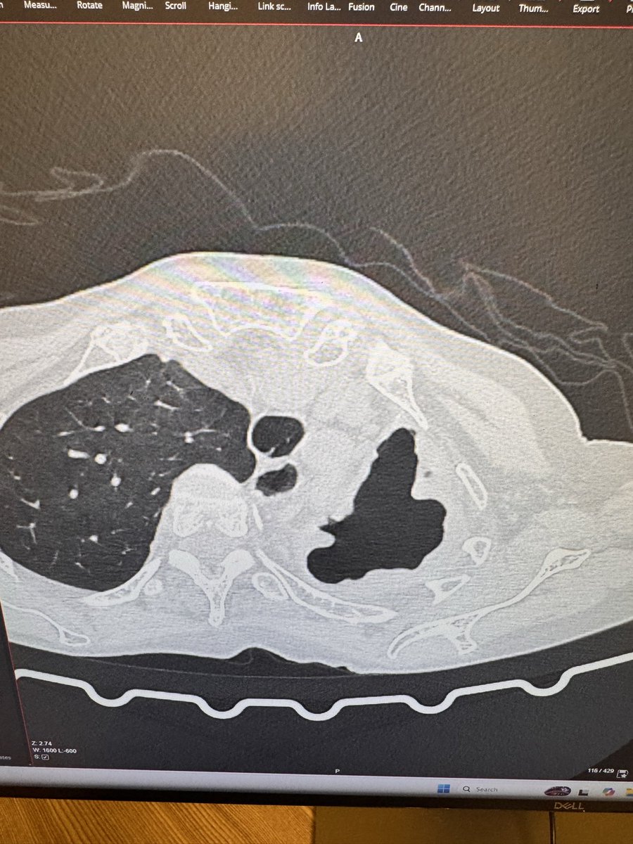 dgonzalezrivas's tweet image. Mission acomplished in Liberia, Africa with our mobile unit. We did 7 Uniportal VATS complex cases including 2 pneumonectomies for destroyed lung due to TBC and one lobectomy for aspergilloma. I want to thank all the team for the amazing work and commitment