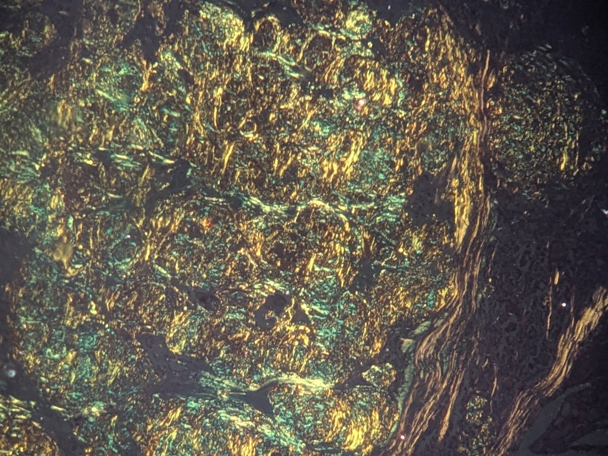 pathognosis22's tweet photo. Amyloid, congo red, bright field- salmon fish meat colour, polarizer- apple green birefringence (amyloid) , yellow-orange birefringence (collagen) #MTC #Congo_red #Amyloid #endopath #pathognosis #path https://t.co/Ym6gwXOTkm