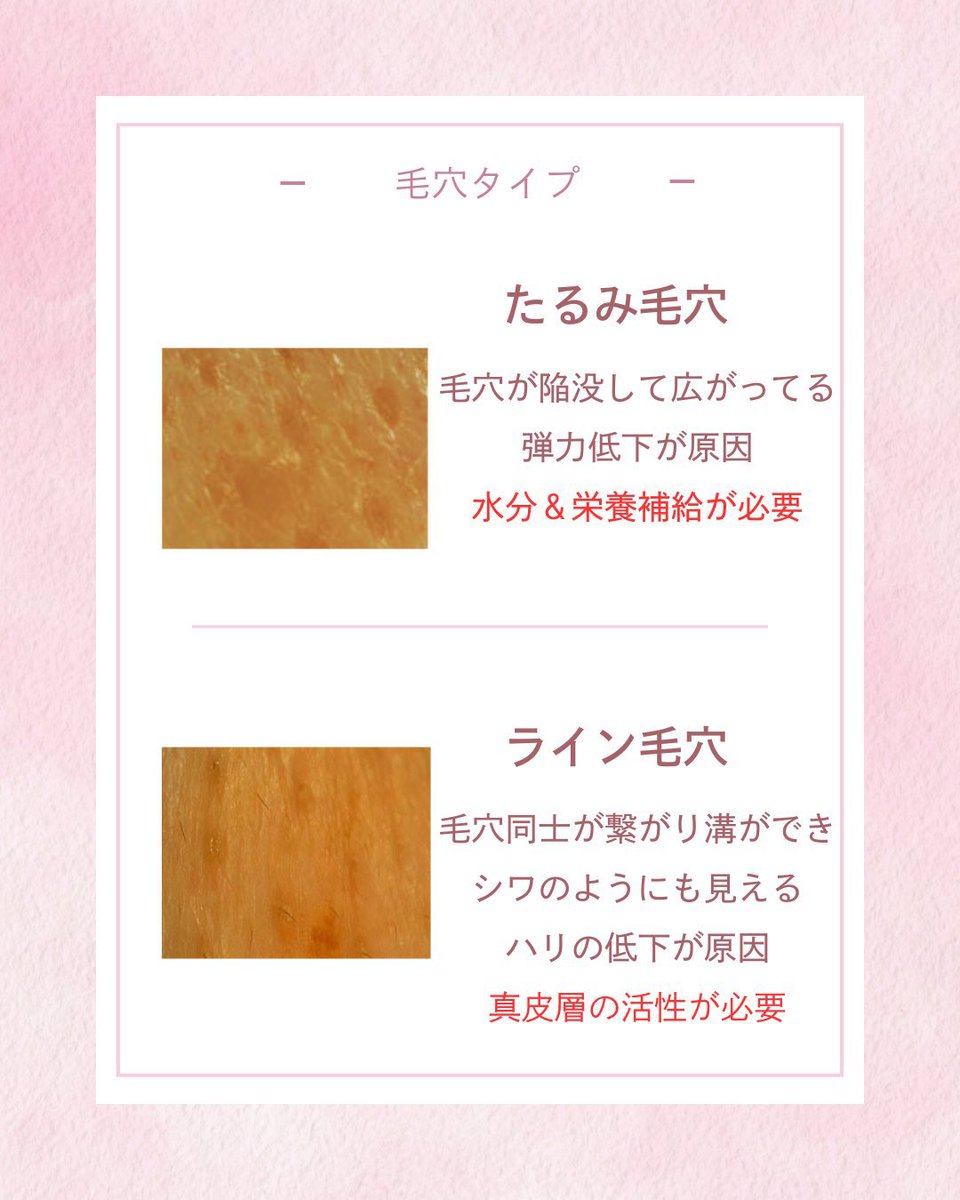 ymchan24's tweet photo. 肌を綺麗にしたい人、ニキビなくしたい人はまず自分の毛穴を知ること☝️
毛穴は9種類あってそれぞれ原因と解決策が異なるから自分に合ったケアするのが近道❤️‍🔥
これ参考にしてみて🙂‍↕️ https://t.co/69wp17Lj4a