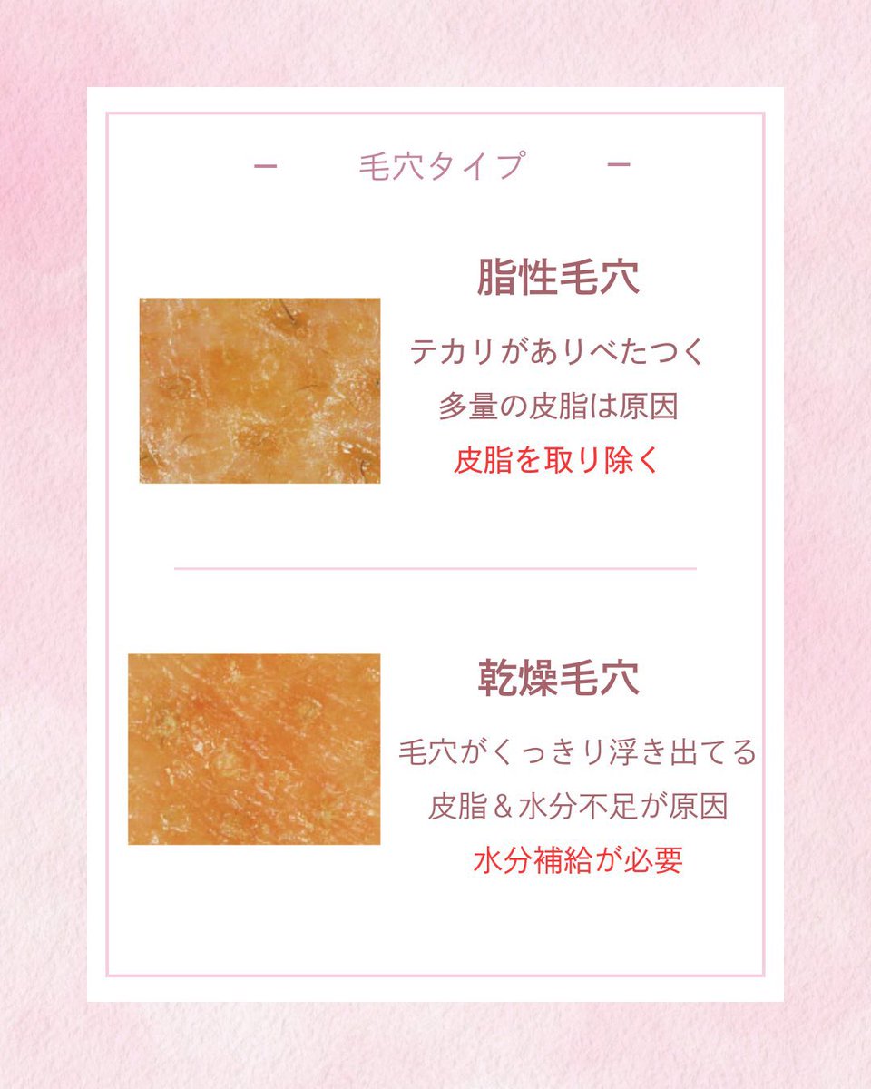 ymchan24's tweet photo. 肌を綺麗にしたい人、ニキビなくしたい人はまず自分の毛穴を知ること☝️
毛穴は9種類あってそれぞれ原因と解決策が異なるから自分に合ったケアするのが近道❤️‍🔥
これ参考にしてみて🙂‍↕️ https://t.co/69wp17Lj4a