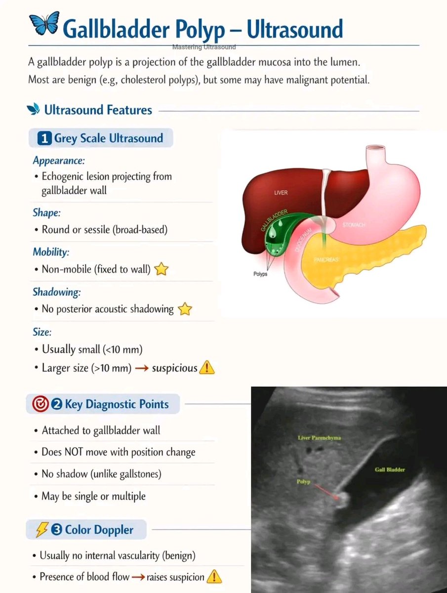 mznljrdy47597's tweet image. 🦋 Gallbladder Polyp - Ultrasound 
#masteringultrasound #ultrasound 
#ultrasoundscan #gallbladderpolyp