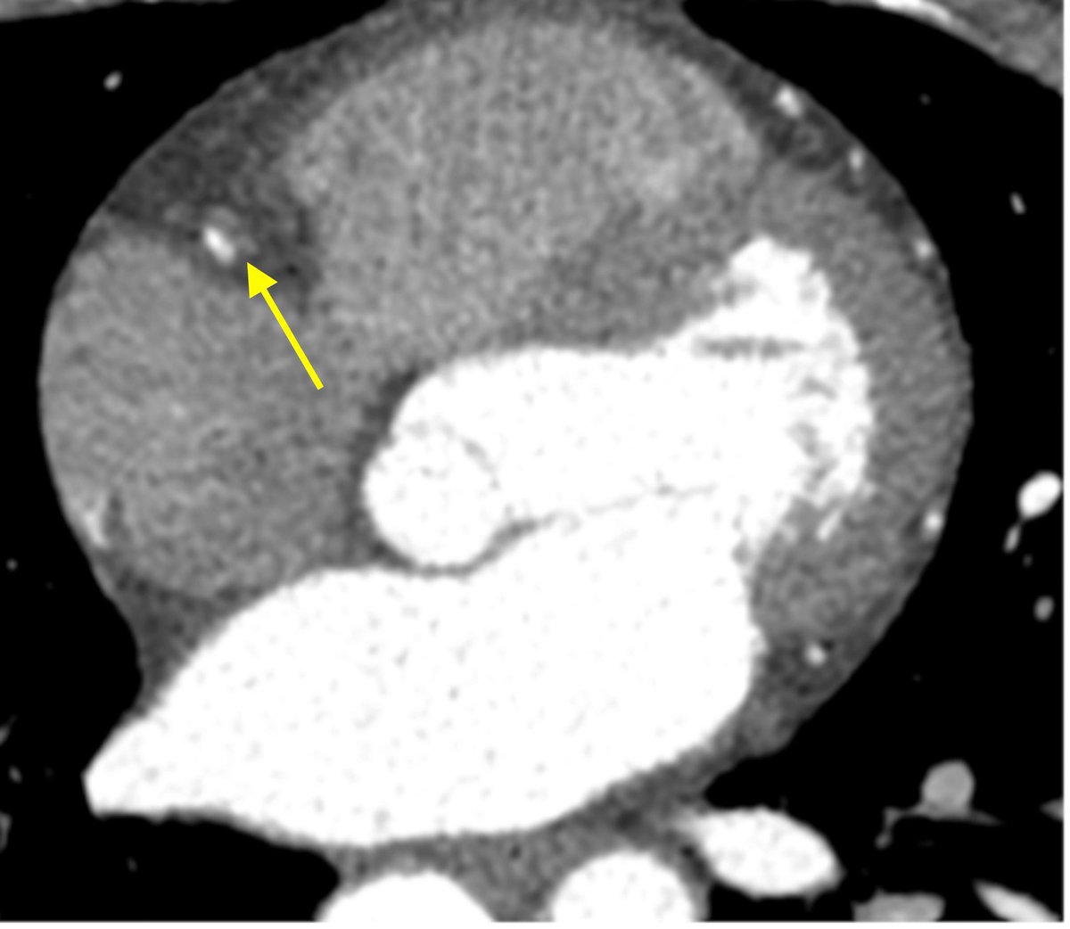Cardio_Rounds's tweet photo. Diagnosis and what causes this? Source: Cureus https://t.co/Byz9b2LMGU