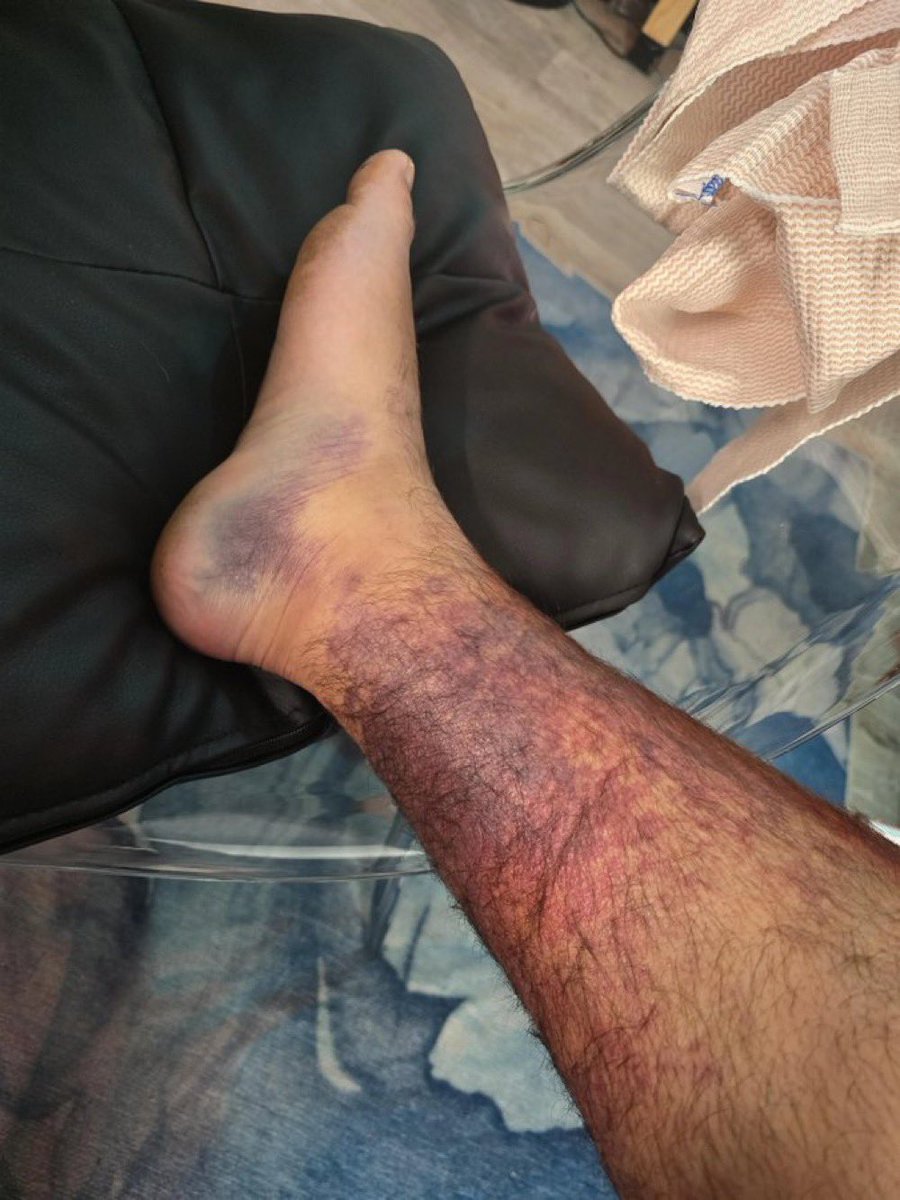 TheMcBlack's tweet image. Juan Soto Pacheco tuvo que salir en el primer inning por una lesión de pantorrilla 😱 Esperemos pronta recuperación #Mets #Soto