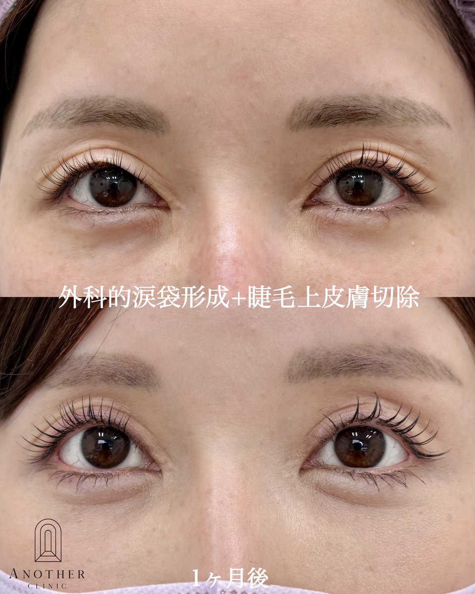 biyou_keinsym's tweet photo. 【外科的涙袋形成】

続々とはじめるクリニック増えてますが、そもそもそんなに適応が多い施術ではないので、かなり私は懐疑的です.
いくつか注意点あるので羅列です☺︎

・やり方を明かしていない独自の方法！みたいなのは、、、😞
・一緒にヒアルや脂肪注入もしているのにそれを表記していないクリニックも多い
・1週間後の症例しか載せてないのも注意
・真皮移植は個人的にはまだ様子見が��