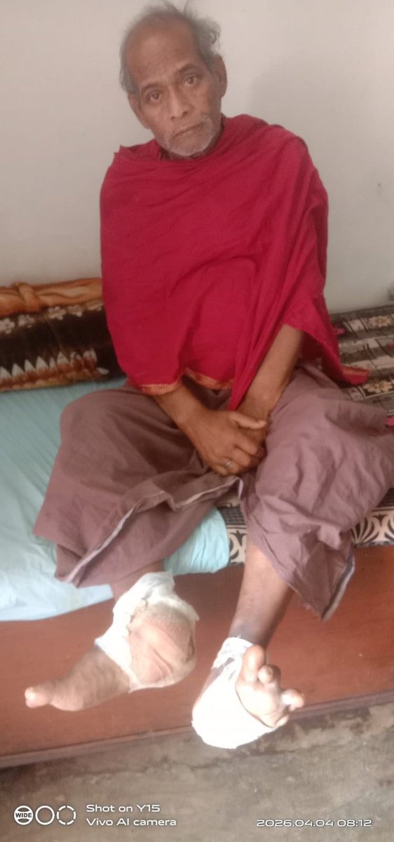 sakaldeo_mirdha's tweet photo. गिरिडीह पपरवाटांड के सतेन्द्र सिंह यह गंभीर घाव लेकर कई वर्षो से परेशान हैं उचित इलाज नही मिलने कारण अब मांस गलनें लगा है,15पहले रिम्स गये थे लेकिन भर्ती नही लिया
सर निवेदन होगा  @ranchi_rims मे एडमिट हेतू मदद करें 🙏
M -9031516657
@HemantSorenJMM 
@IrfanAnsariMLA 
@kumarsudivya https://t.co/S5wBw1OLiw
