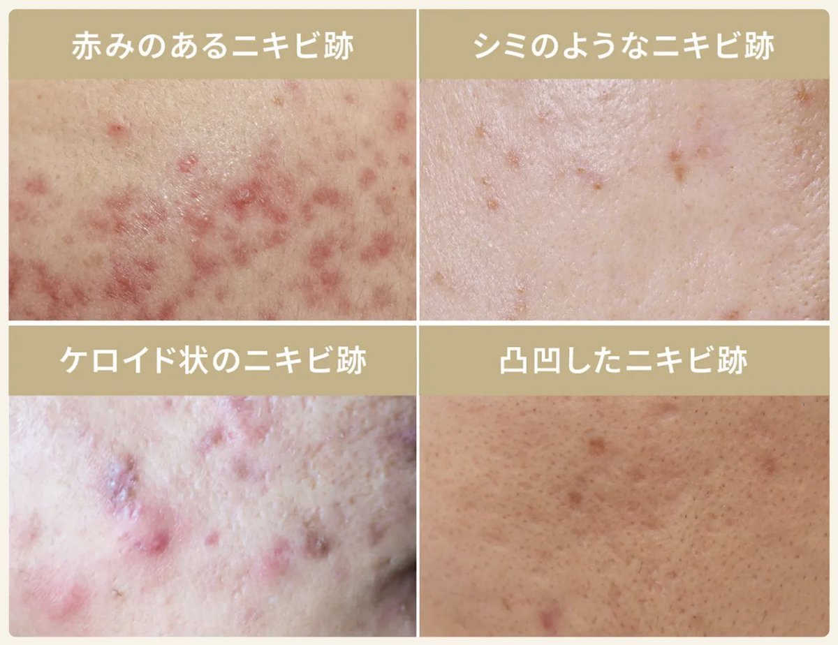 master_biyou's tweet photo. 【ニキビ跡、種類で治療変わる】

これ知らずにやってるやつ多いけど
ニキビ跡は『全部別物』

■ 赤みのあるニキビ跡（左上）
→ Vビーム / IPL
👉 血管にアプローチ

■ シミのようなニキビ跡（右上）
→ トラネキサム酸 / ハイドロキノン / レーザー
👉 色素沈着（PIH）は美白＋光

■ ケロイド状のニキビ跡（左下）
→ ステロイド注射 / 内服
👉 盛り上がりは“抑える治療”

■ 凹凸したニキビ跡（右下）
→ サブシジョン / フラクショナルレーザー
👉 クレーターは“構造改善”