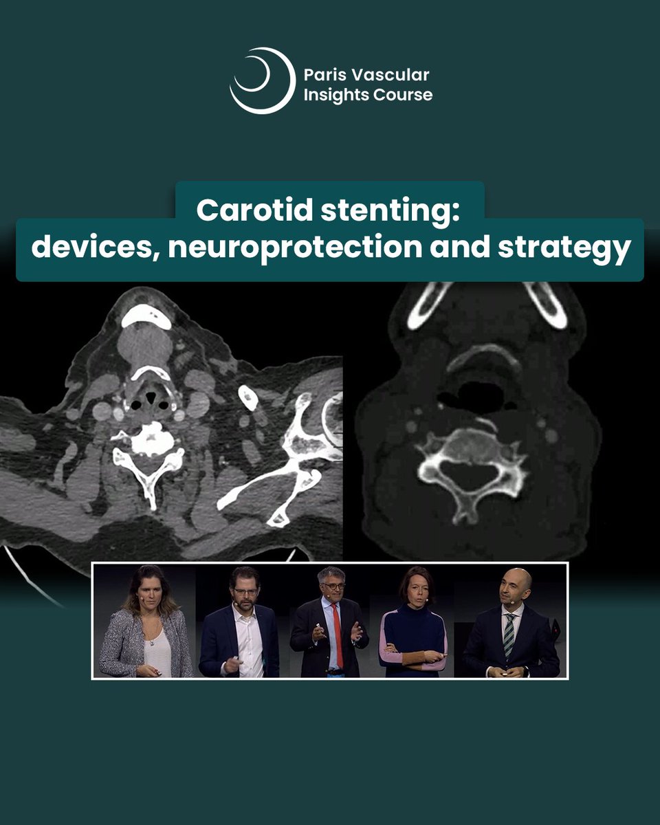 ParisVascular's tweet image. Struggling with complex carotid cases? 🤔
This #PVI 2025 session breaks down device choice, neuroprotection, and procedural strategy, with insights from CREST2, ECST2, and real-world cases, including vertebral lesions and nonagenarian patients. ➡️ brnw.ch/21x1jpp