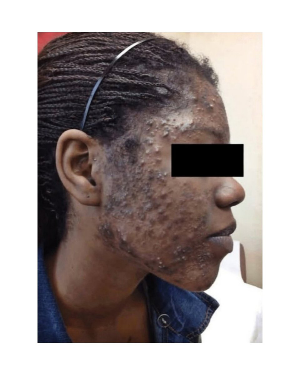 NoFilterSkin's tweet image. Who said Acne has no solution???

#BeforeAndAfter
