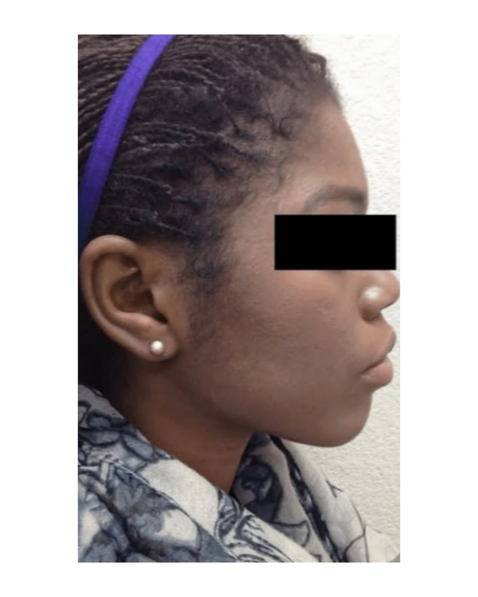 NoFilterSkin's tweet image. Who said Acne has no solution???

#BeforeAndAfter