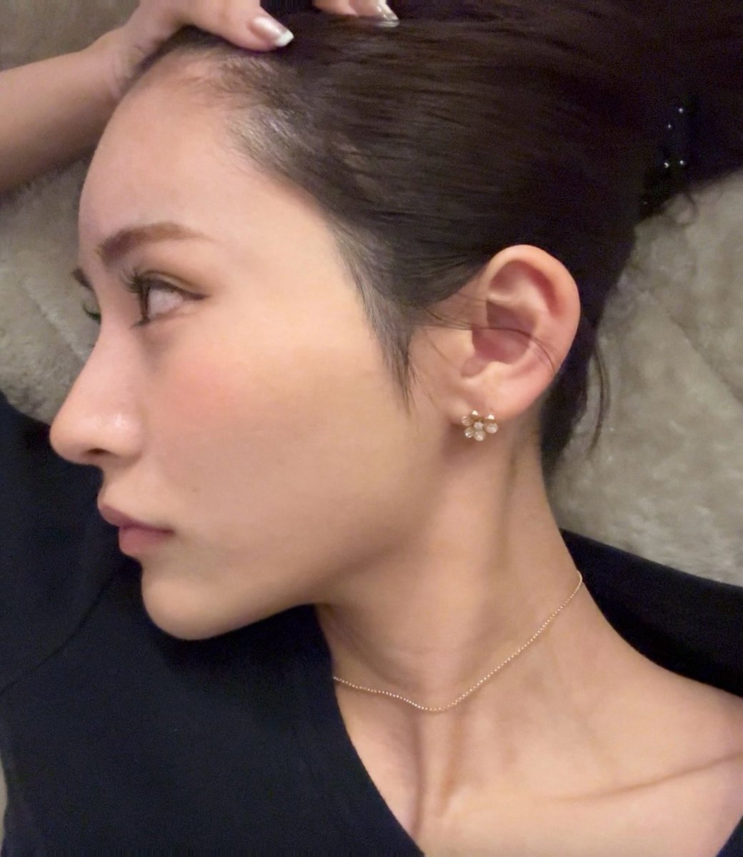 bep_la's tweet photo. DTほとんど終わった？から
やっと執刀医載せる🥺

症例の忘れ鼻がどれも綺麗すぎて
割と即決で手術きめた❗️

東京はまじで予約取りにくいけど
大阪は東京より取りやすい穴場✌︎('ω')✌︎

執刀医はyourfaceの山脇先生
ノマカメ3ヶ月後↓ https://t.co/Ldf9JNTuJ3