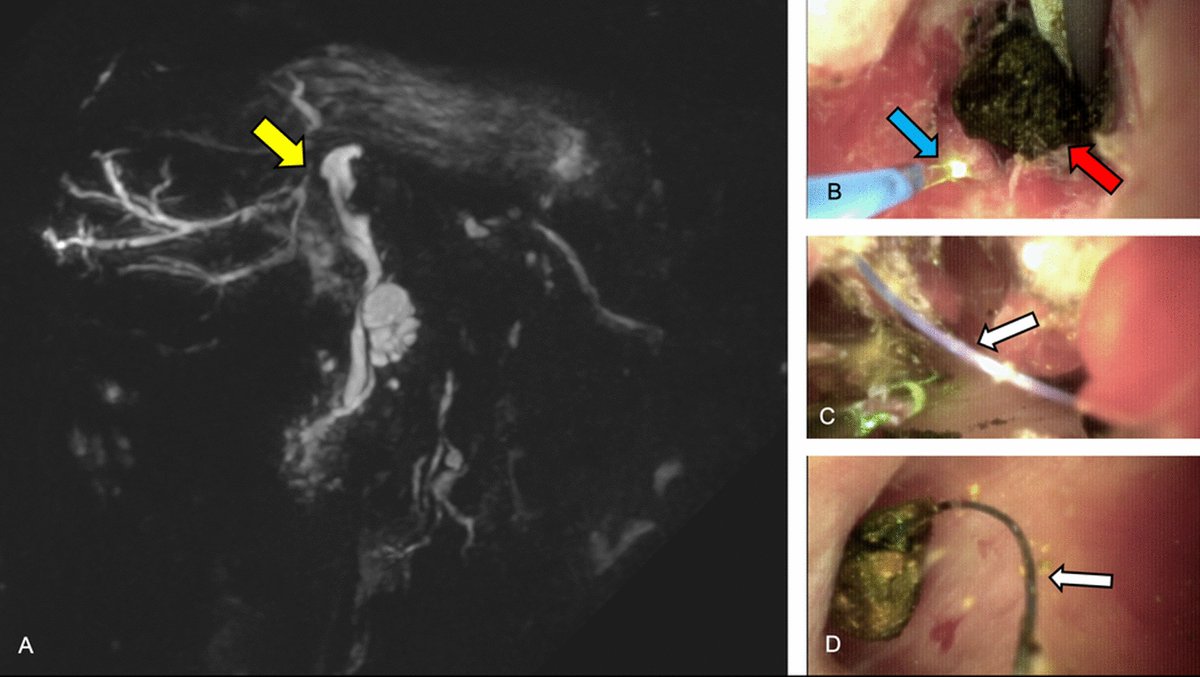 CVIR_Journal's tweet photo. #LettertoEditor 📬
Percutaneous Cholangioscopy Unmasks Foreign-Body Mimics of Biliary Lesions
https://t.co/XIXZ0KEZ6U https://t.co/6ZtpemGO9N