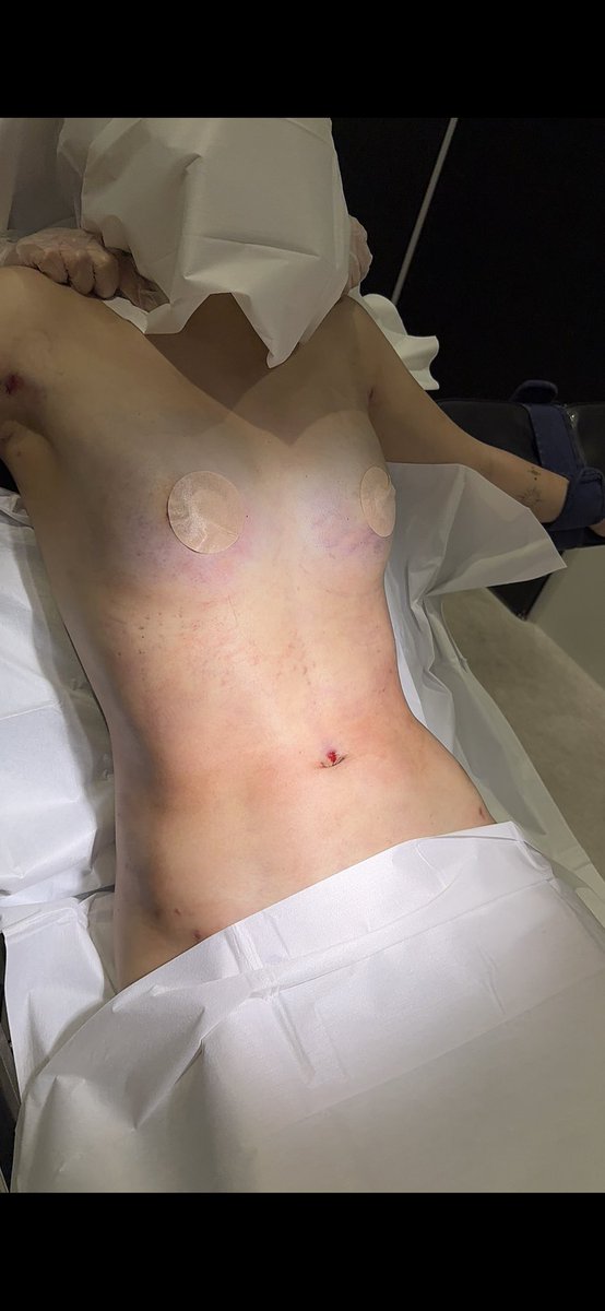 【🥧がAカップ以下の場合の注意点⚠️】

❗️普通にやると一瞬でしこりになります❗️

〈理由〉
Aカップは皮膚のテンションが強い。
つまり🥧の中の圧が高いという事。

圧が高いと、注入した脂肪がしこりになりやすい。
つまり、それに合わせて注入量を少なくする必要があります。

そのため、