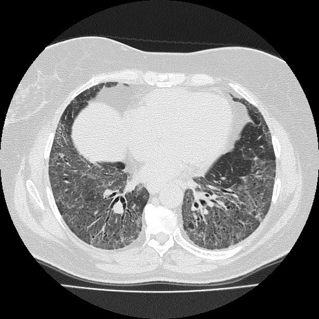 DrAyubaD's tweet photo. TEACHING FILE.‼️‼️☣️

Non specific interstitial pneumonia (NSIP);

NSIP) is the second most common morphological and pathological pattern of interstitial lung diseases after UIP. NSIP is commonly associated with connective tissue disease (CTD), and a multidisciplinary team best decides the underlying diagnosis and management. Seen in adults aged 40-50yrs.
HRCT FINDINGS;
1. Ground glass opacities 
2. Reticular opacities
3. Traction bronchiectasis
4.Lung volume loss
5. Consolidations in advanced cases. 
Note ; the most prominent feature is ground glass opacities.

See attached images.

#Radres #Radiology #Radtwitter