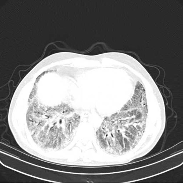 DrAyubaD's tweet photo. TEACHING FILE.‼️‼️☣️

Non specific interstitial pneumonia (NSIP);

NSIP) is the second most common morphological and pathological pattern of interstitial lung diseases after UIP. NSIP is commonly associated with connective tissue disease (CTD), and a multidisciplinary team best decides the underlying diagnosis and management. Seen in adults aged 40-50yrs.
HRCT FINDINGS;
1. Ground glass opacities 
2. Reticular opacities
3. Traction bronchiectasis
4.Lung volume loss
5. Consolidations in advanced cases. 
Note ; the most prominent feature is ground glass opacities.

See attached images.

#Radres #Radiology #Radtwitter