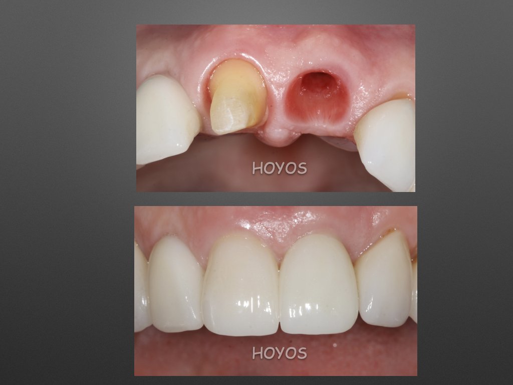 newteethbypro's tweet photo. We used Emax crowns 8 and 9 with same hue. Zr abutment on 9 matching color on  8 prep.  The value looks different. The patient is happy. https://t.co/ZDM4vMQZSD