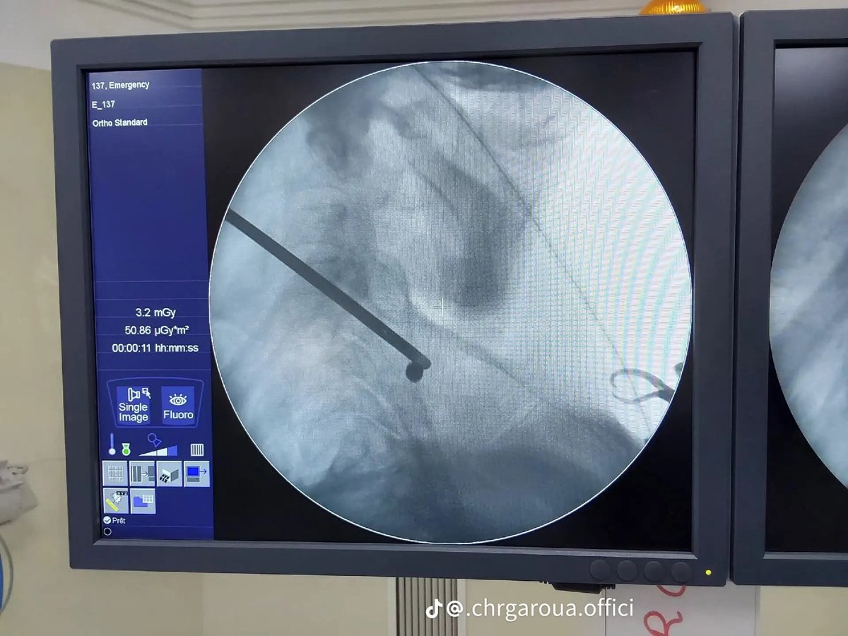 TheCameroonianZ's tweet image. Extraction réussie d’éclats de balles logés dans la tête et le cou d’un patient au Centre Hospitalier Régional de Garoua.

#Cameroon 🫆