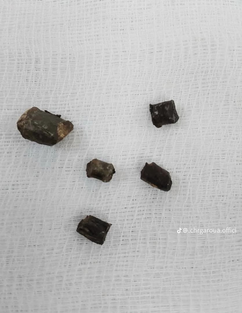 TheCameroonianZ's tweet image. Extraction réussie d’éclats de balles logés dans la tête et le cou d’un patient au Centre Hospitalier Régional de Garoua.

#Cameroon 🫆