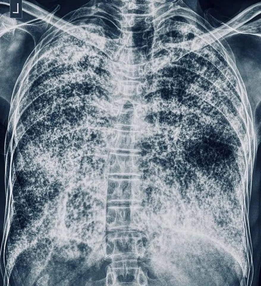 daoo100's tweet image. Sandstorm lungs on CXR in a breathless patient? Diagnosis ❓ 

A) Miliary TB
B) Pulmonary edema
C) Alveolar microlithiasis
D) Metastatic calcification
                                                               #MedX ?
