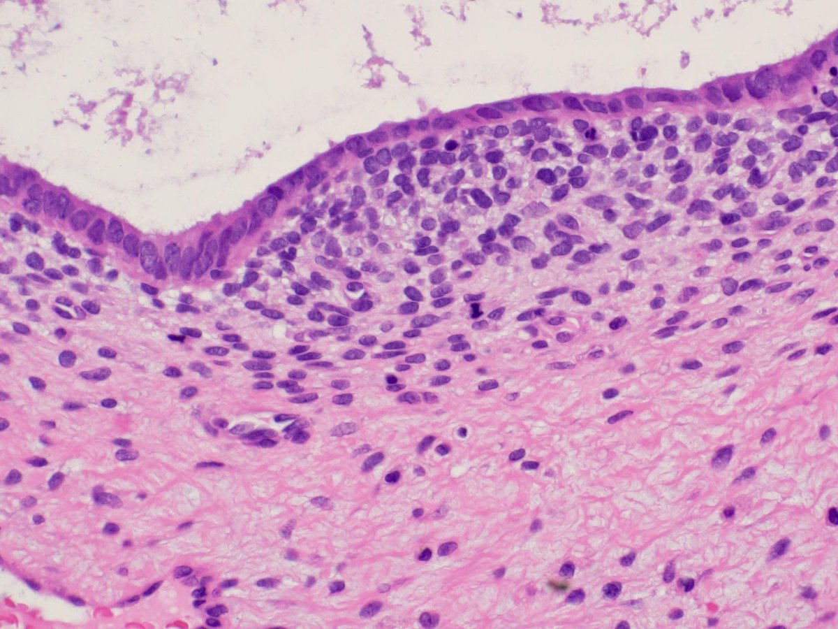 DrCycloPath's tweet image. A 62-year-old woman presents with a polypoid intrauterine mass. 
Aggressive cases of this tumor demonstrate: 
A) JAZF1::SUZ12 fusion
B) FOXL2 mutation
C) DICER1 mutation
D) MYBL1 amplification

#PathQuiz 🔬🧬
#Pathology #GYNPath #MolecularPath 
Clue in caption 🧐