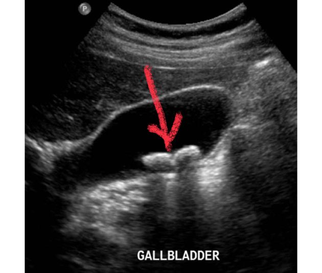 DrAyubaD's tweet image. INCIDENTAL FINDING : Patient is asymptomatic.

What is shown by the RED ARROWS in the gallbladder?
#Radres #Radiology #Medx