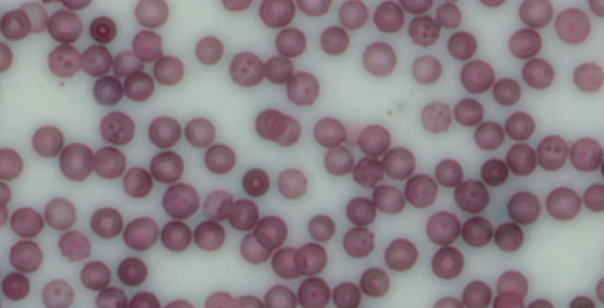 serg9001's tweet photo. Platelets adhering to the surface of red blood cells https://t.co/lfvkUbneQ4