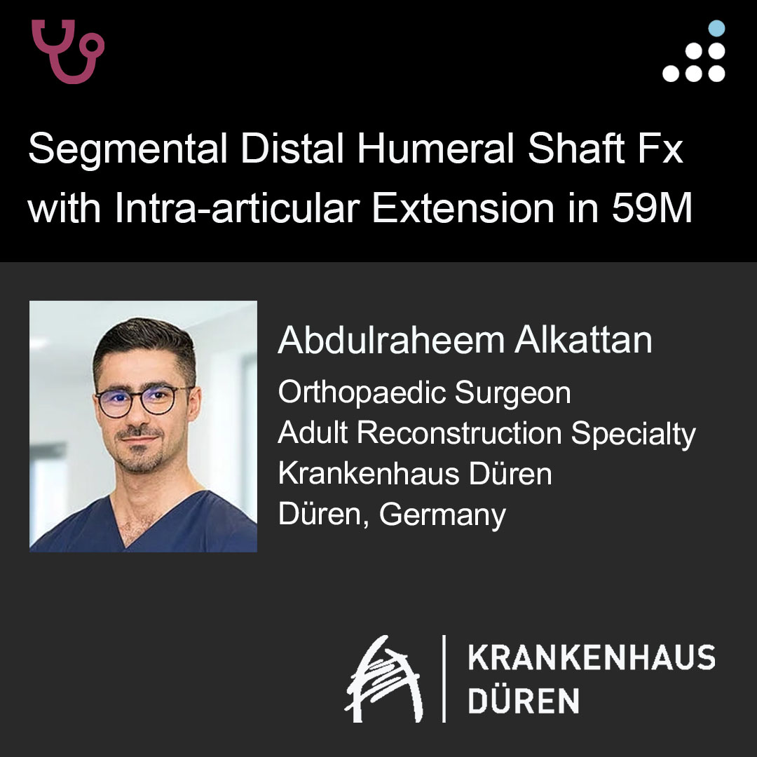 orthobullets's tweet image. Here is a new case by Dr. Abdulraheem Alkattan and Krankenhaus Düren.

SEGMENTAL DISTAL HUMERAL SHAFT FX WITH INTRA-ARTICULAR EXTENSION IN 59M

How would you manage this #orthotwitter?

Vote on this case for CME: orthobullets.tiny.us/bdehvsvt