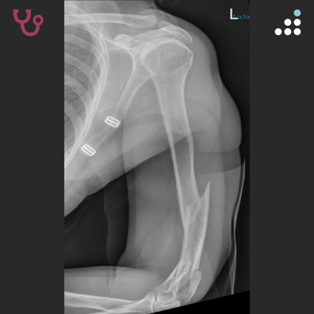 orthobullets's tweet image. Here is a new case by Dr. Abdulraheem Alkattan and Krankenhaus Düren.

SEGMENTAL DISTAL HUMERAL SHAFT FX WITH INTRA-ARTICULAR EXTENSION IN 59M

How would you manage this #orthotwitter?

Vote on this case for CME: orthobullets.tiny.us/bdehvsvt